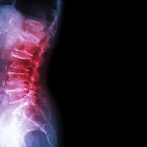 chronic back pain