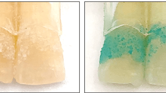tooth decay
