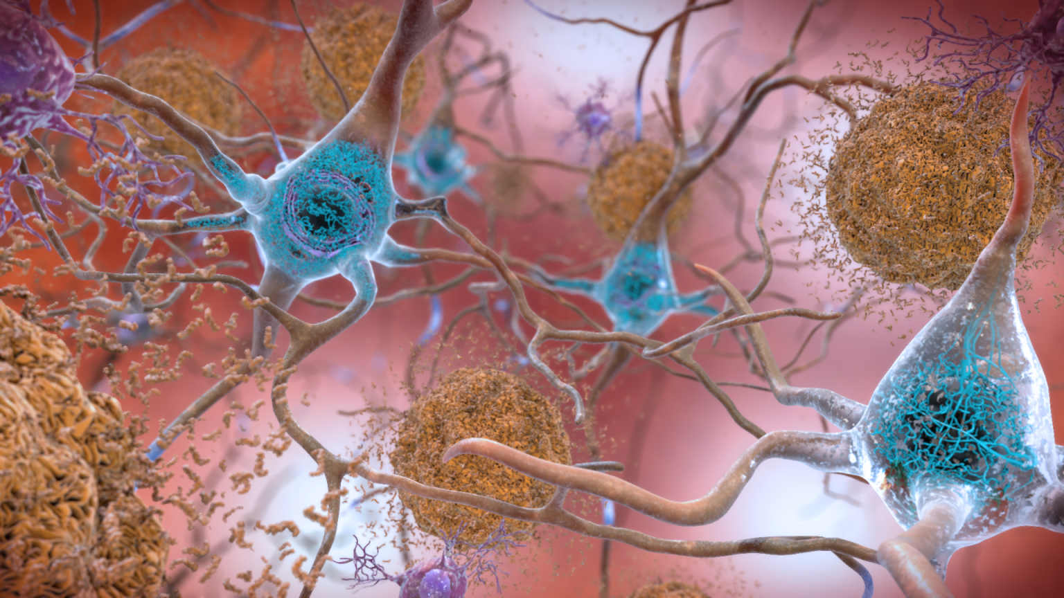 Beta-amyloid plaques and tau proteins assault neurons in a brain changed by Alzheimer's disease