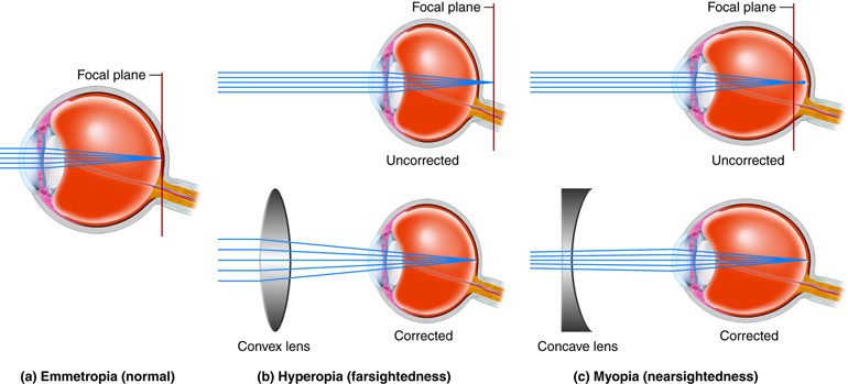 Diagram showing normal vision, hyperopia corrected with a convex lens, and myopia corrected with a concave lens, illustrating how light focuses on the retina—principles foundational to the science of LASIK.