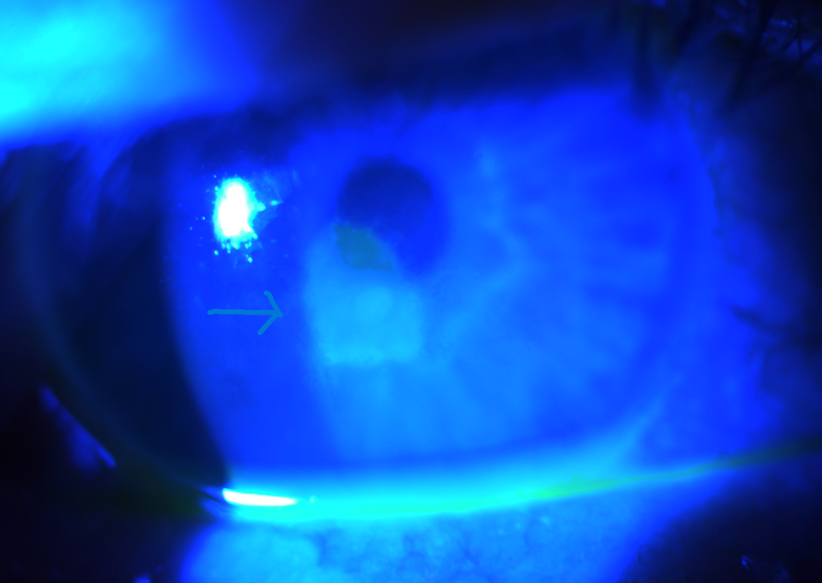 Close-up of a human eye illuminated by blue light, showing a highlighted corneal lesion with an arrow pointing to the affected area—an important detail in understanding the science of LASIK and its effects on ocular health.